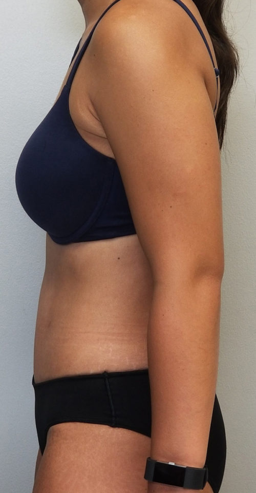 Tummy tuck (Abdominoplasty)