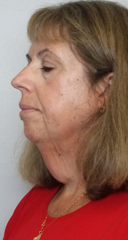 Neck Lift