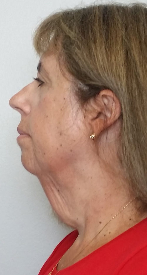 Neck Lift