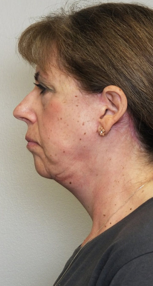 Neck Lift