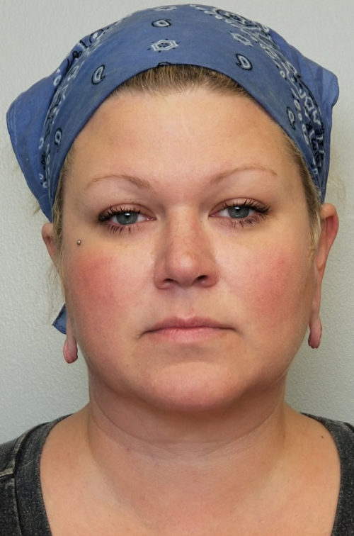 Otoplasty/Cosmetic Ear Surgery Case 10812 Before Photo Otoplasty/Cosmetic Ear Surgery