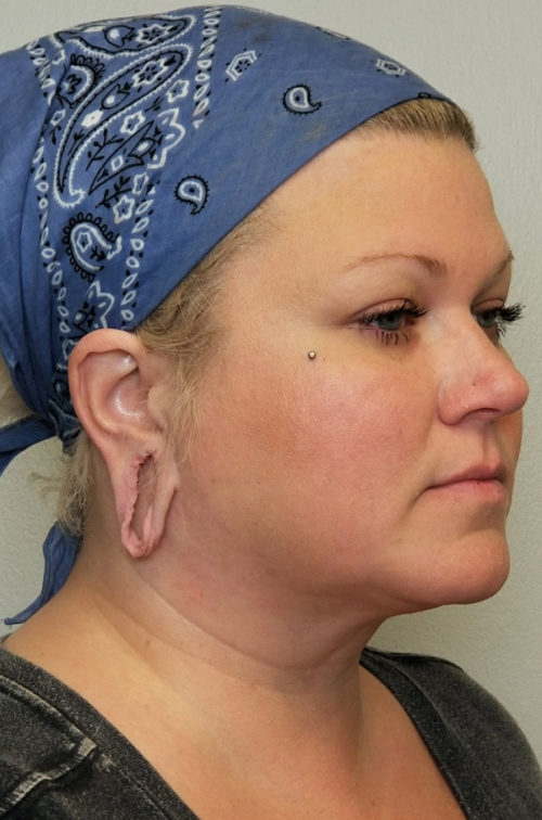 Otoplasty/Cosmetic Ear Surgery Case 10812 Before Photo Otoplasty/Cosmetic Ear Surgery