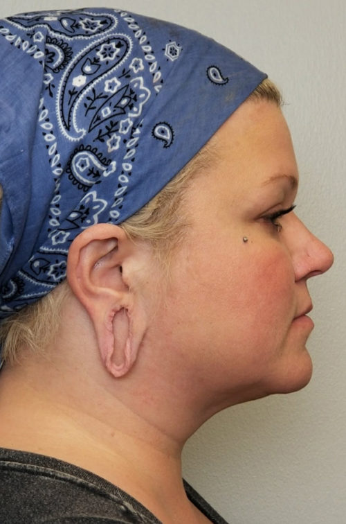 Otoplasty/Cosmetic Ear Surgery Case 10812 Before Photo Otoplasty/Cosmetic Ear Surgery