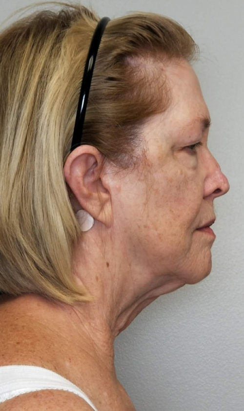 Facelift Case 10813 Before Photo Facelift