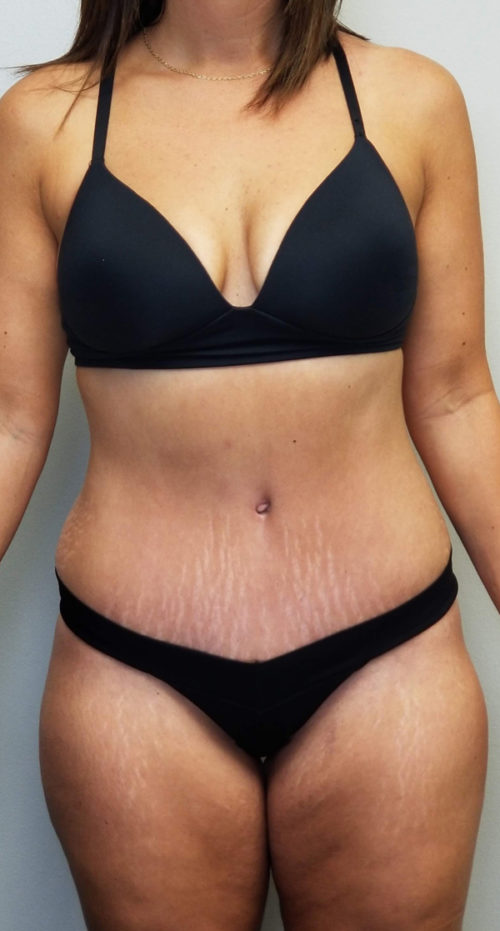 Tummy tuck (Abdominoplasty)