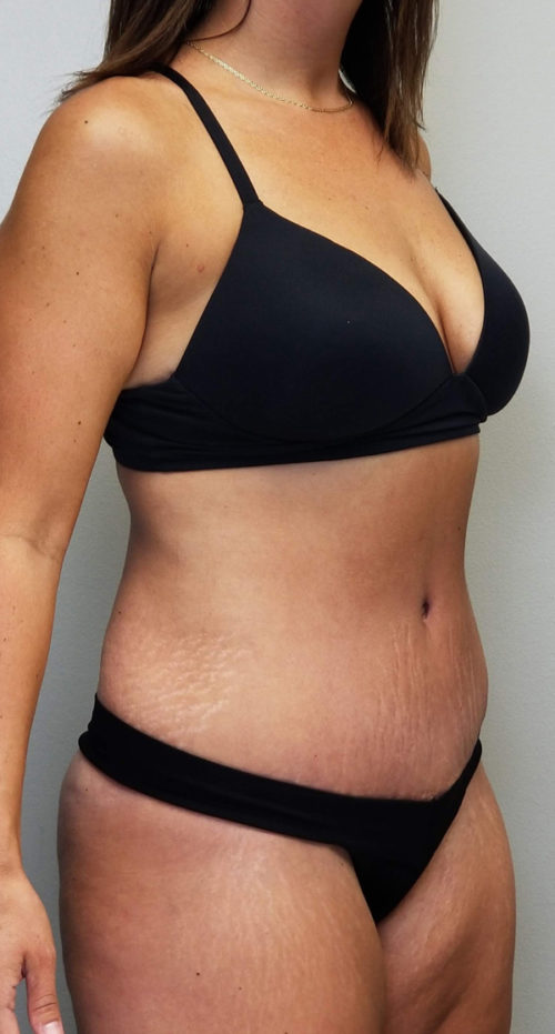 Tummy tuck (Abdominoplasty)