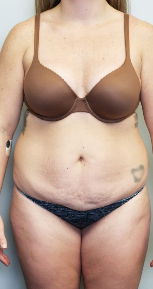 Tummy tuck (Abdominoplasty) Case 10806 Before Photo Tummy tuck (Abdominoplasty)