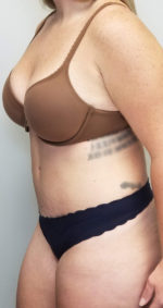 Tummy tuck (Abdominoplasty)