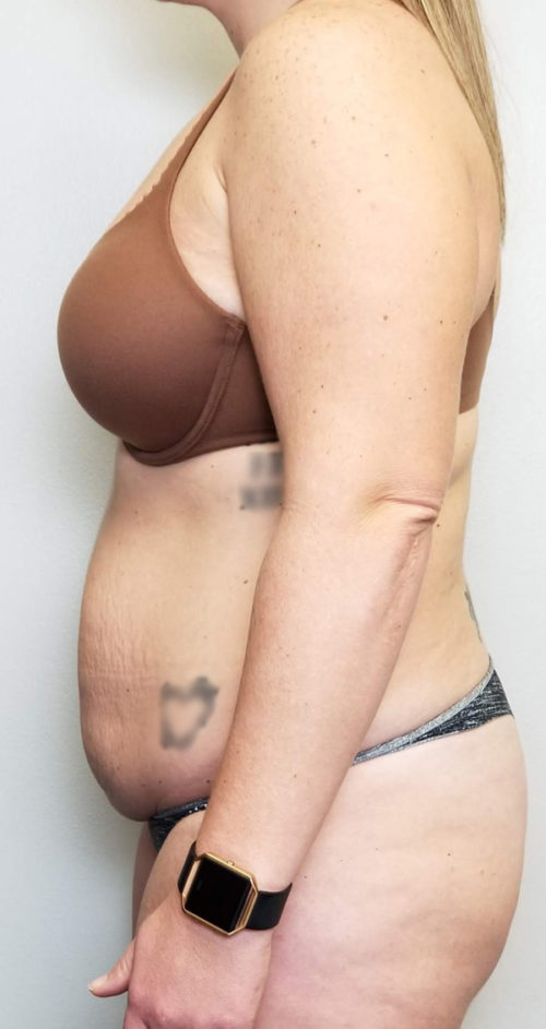 Tummy tuck (Abdominoplasty)