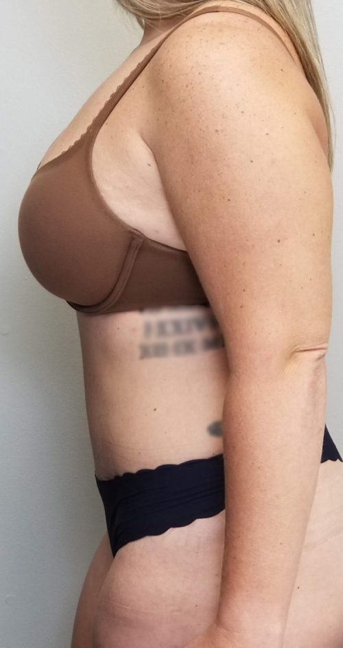 Tummy tuck (Abdominoplasty) Case 10806 After Photo Tummy tuck (Abdominoplasty)