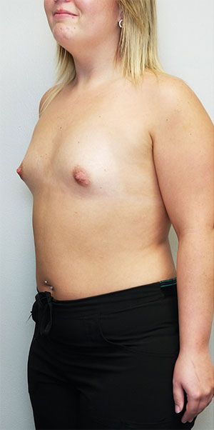 Breast Augmentation Case 10911 Before Photo Breast Augmentation