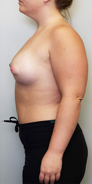 Breast Augmentation Case 10911 After Photo Breast Augmentation