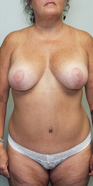 Breast Lift Case 10925 After Photo Breast Lift