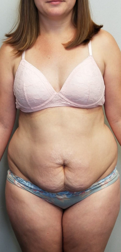 Tummy tuck (Abdominoplasty)