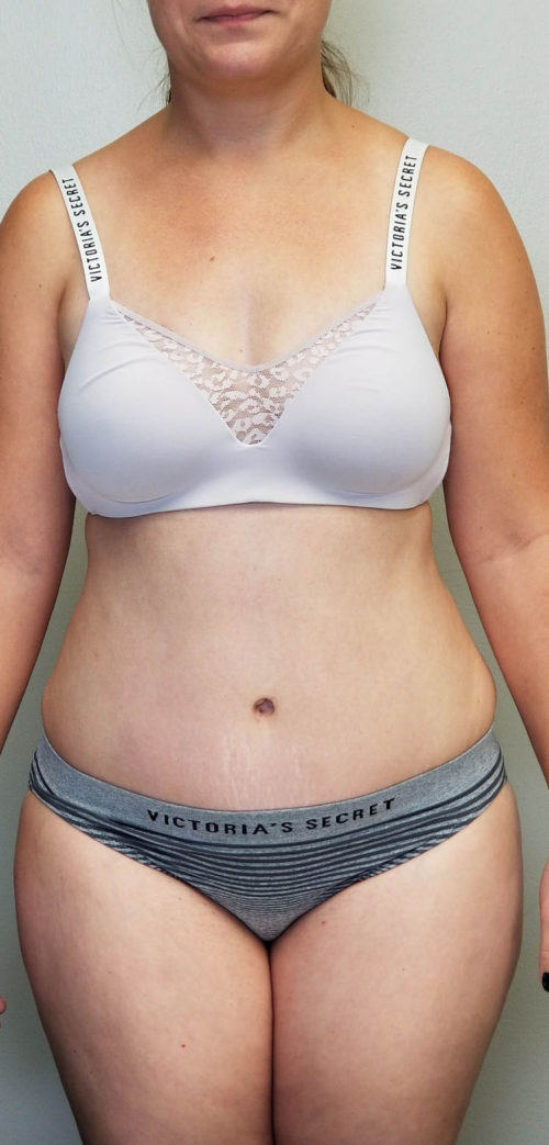 Tummy tuck (Abdominoplasty)