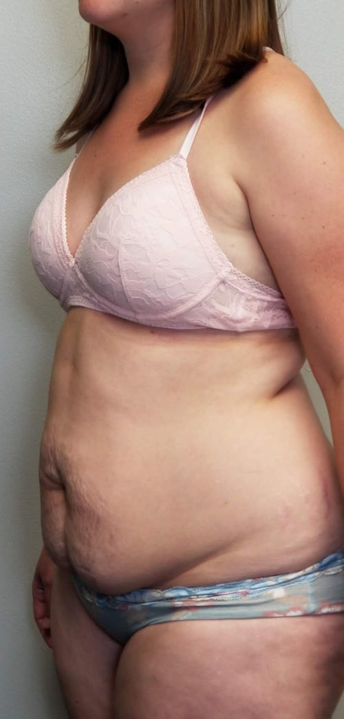 Tummy tuck (Abdominoplasty) Case 10933 Before Photo Tummy tuck (Abdominoplasty)