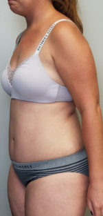 Tummy tuck (Abdominoplasty)