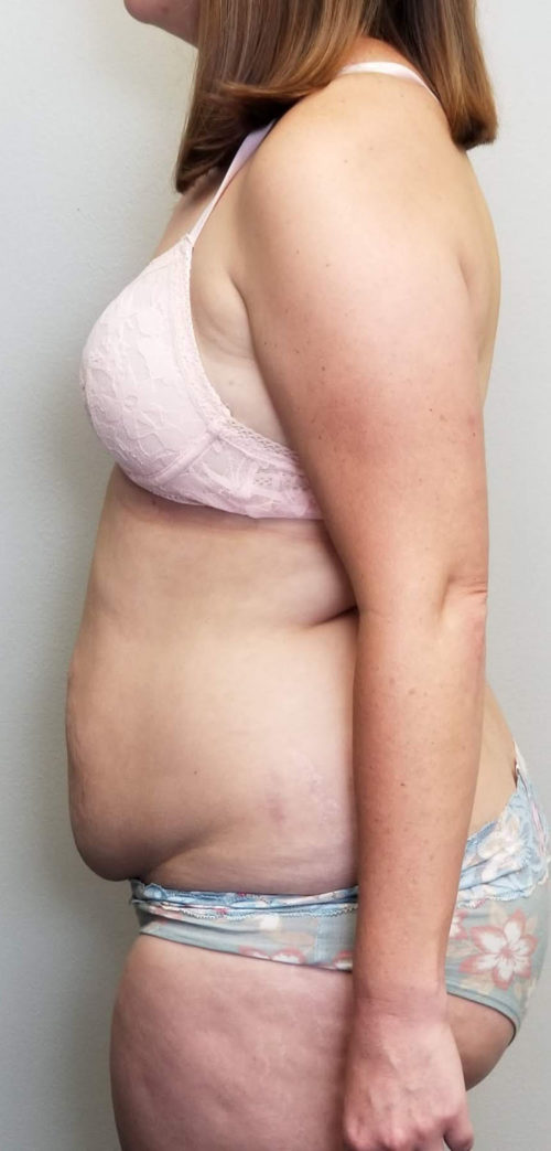 Tummy tuck (Abdominoplasty) Case 10933 Before Photo Tummy tuck (Abdominoplasty)