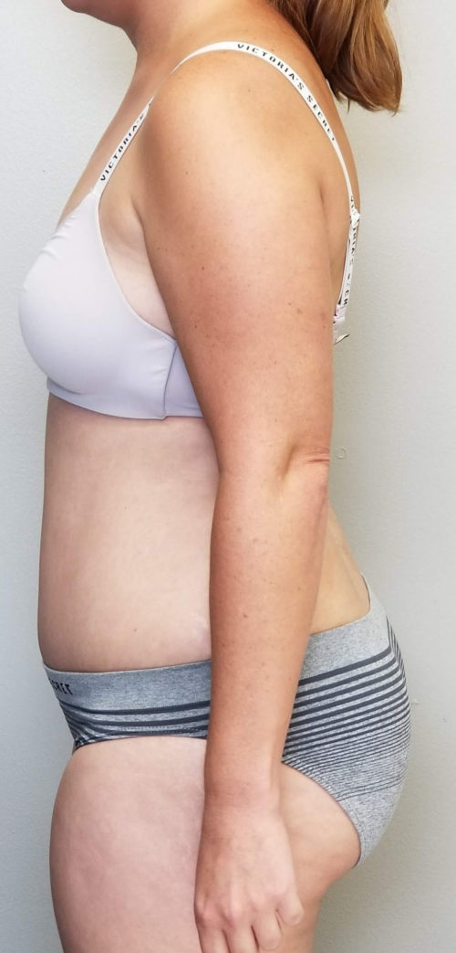 Tummy tuck (Abdominoplasty) Case 10933 After Photo Tummy tuck (Abdominoplasty)