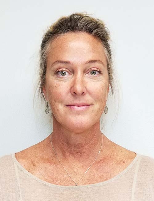 Brow Lift/Forehead Rejuvenation Case 11136 After Photo Brow Lift/Forehead Rejuvenation