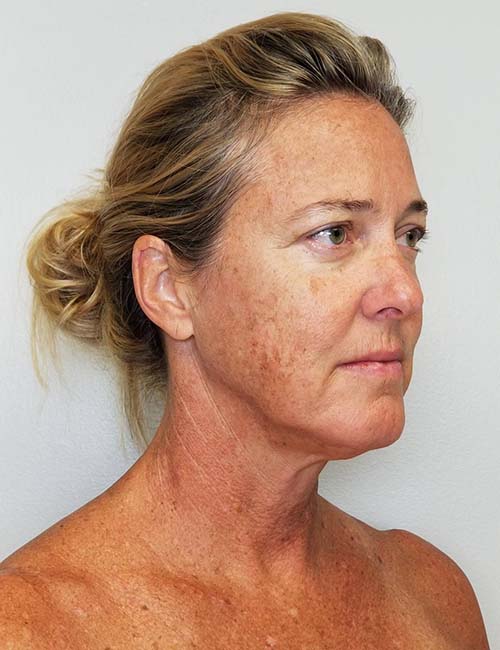Brow Lift/Forehead Rejuvenation Case 11136 Before Photo Brow Lift/Forehead Rejuvenation