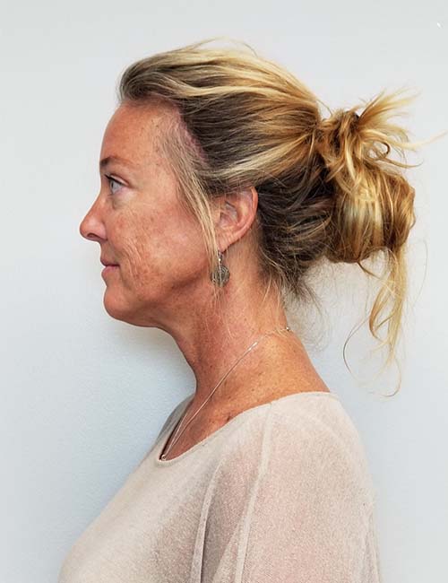 Brow Lift/Forehead Rejuvenation Case 11136 After Photo Brow Lift/Forehead Rejuvenation