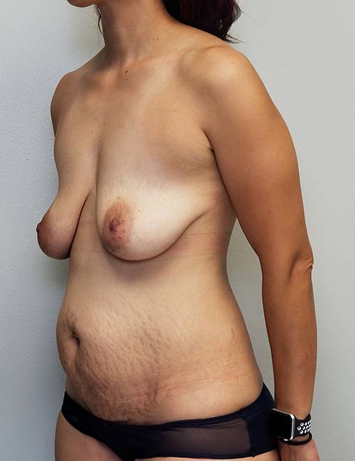 Breast Reconstruction Case 11171 Before Photo Breast Reconstruction