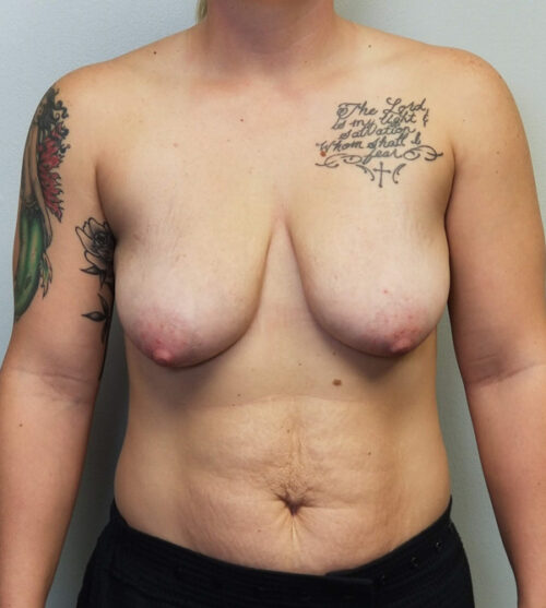 Breast Lift Case 11222 Before Photo Breast Lift