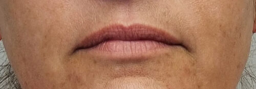 Valentine lip lift Case 11229 Before Photo Valentine lip lift