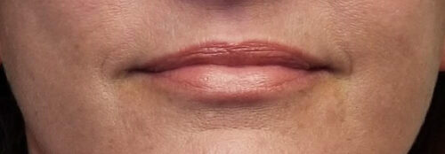 Valentine lip lift Case 11229 After Photo Valentine lip lift