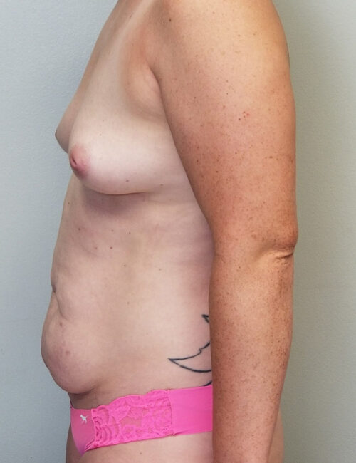 Mommy Makeover Case 11232 Before Photo Mommy Makeover