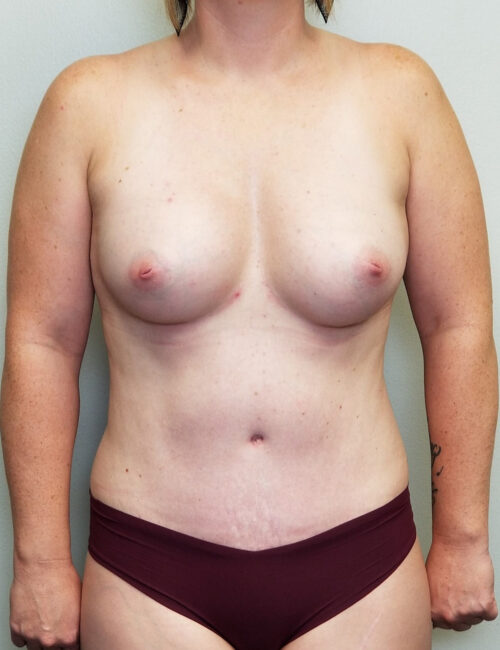 Mommy Makeover Case 11232 After Photo Mommy Makeover