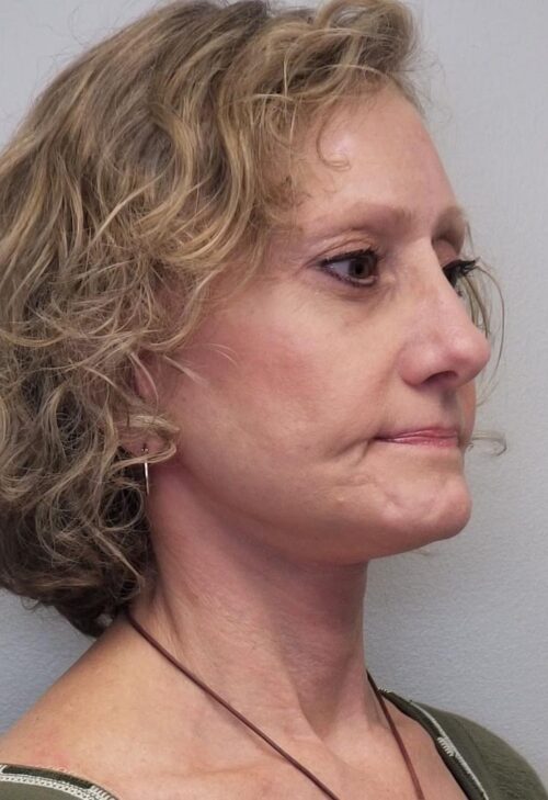 Facelift Case 11253 After Photo Facelift