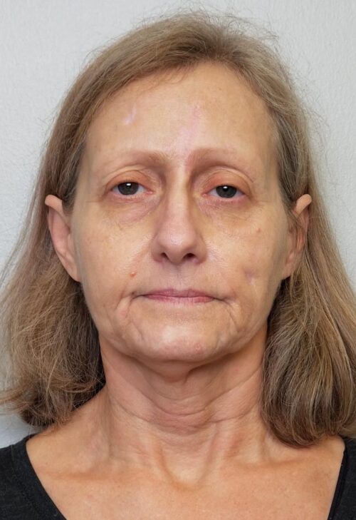 Facelift Case 11253 Before Photo Facelift