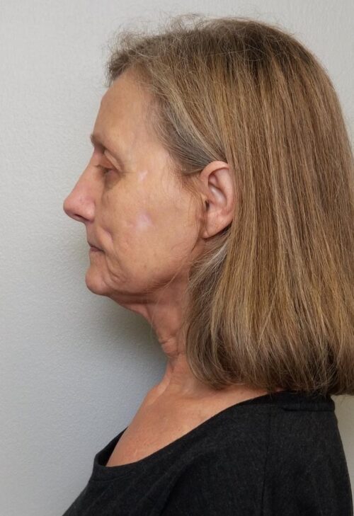 Facelift Case 11253 Before Photo Facelift