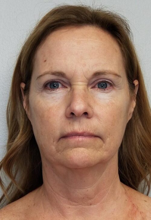 Facelift Case 11260 Before Photo Facelift
