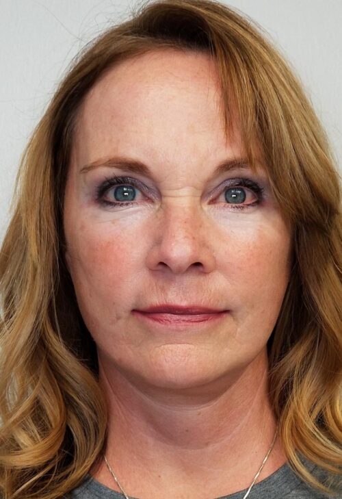 Facelift Case 11260 After Photo Facelift