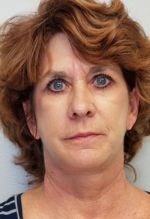 Facelift Case 11267 After Photo Facelift