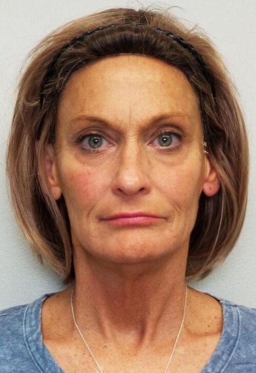 Facelift Case 11270 Before Photo Facelift