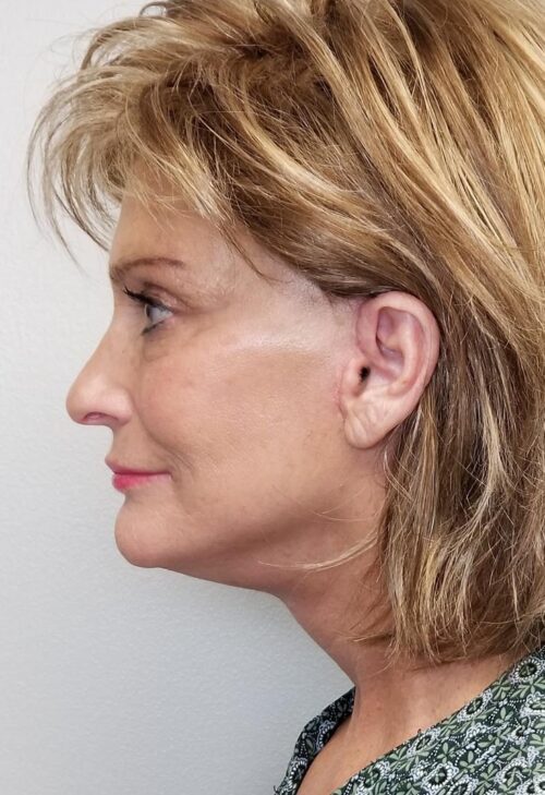 Facelift Case 11270 After Photo Facelift