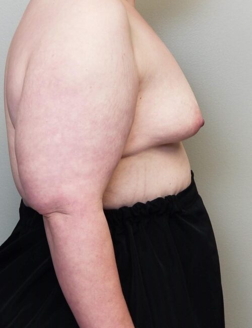 Breast Augmentation Case 11296 Before Photo Breast Augmentation