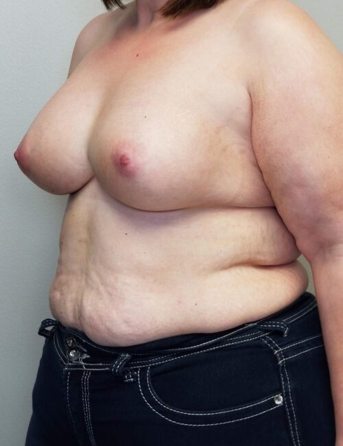 Breast Augmentation Case 11296 After Photo Breast Augmentation