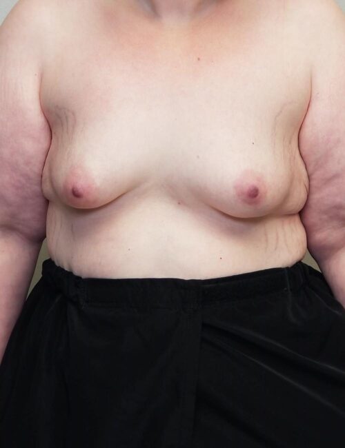 Breast Augmentation Case 11296 Before Photo Breast Augmentation