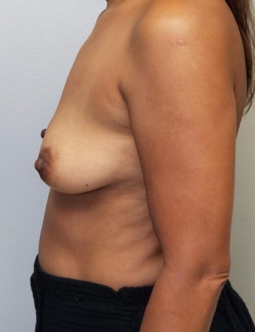 Breast Augmentation Case 11303 Before Photo Breast Augmentation