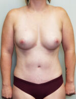 Breast Augmentation