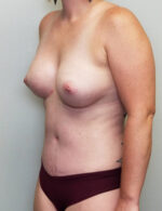 Breast Augmentation