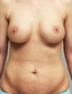 Breast Augmentation