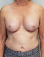 Breast Augmentation