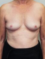 Breast Augmentation