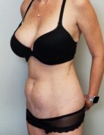 Tummy tuck (Abdominoplasty)